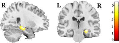 Effect of Season of Birth on Hippocampus Volume in a Transdiagnostic Sample of Patients With Depression and Schizophrenia